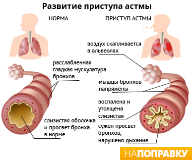 Развитие приступа астмы