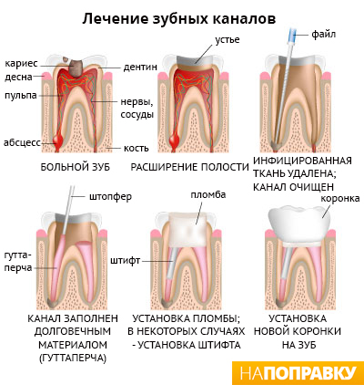последовательность лечения зубных каналов