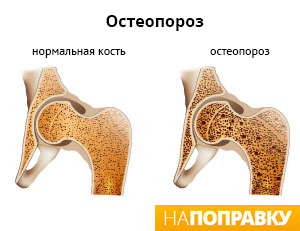 сравнение анатомии нормальной кости и кости с остеопорозом