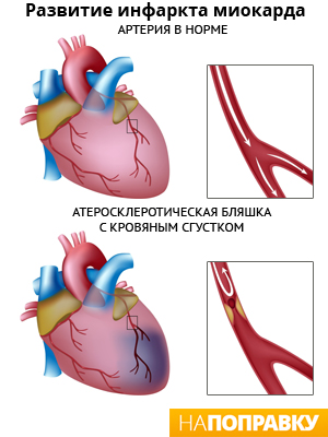 Как развивается инфаркт