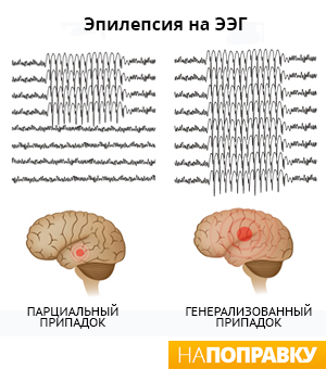 Виды припадков при эпилепсии на ЭЭГ (схема)