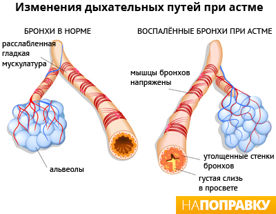 патологическая анатомия бронхиальной астмы.jpg
