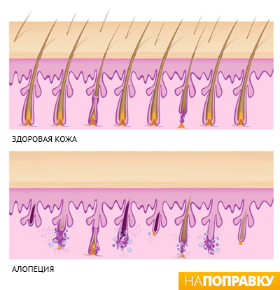 Схема строения кожи в норме и при алопеции