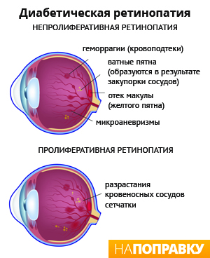 диабетическая ретинопатия