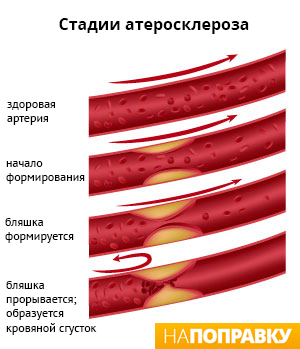 состояние артерий при атеросклерозе