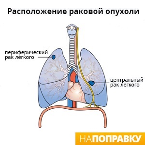Центральный и периферический рак легких (схема).jpg