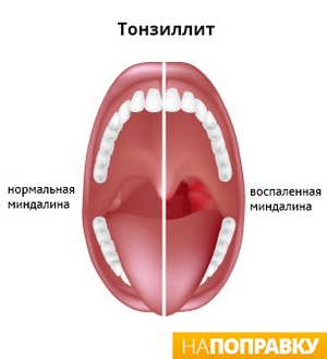 сравнение миндалин здорового и воспаленного горла