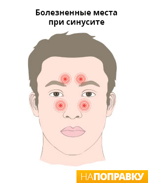 точки локализации боли при воспалении пазух носа