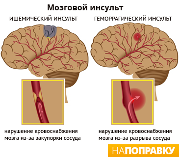 Нарушение мозгового кровообращения