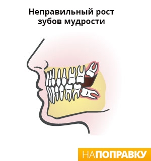 схема роста зубов мудрости.jpg
