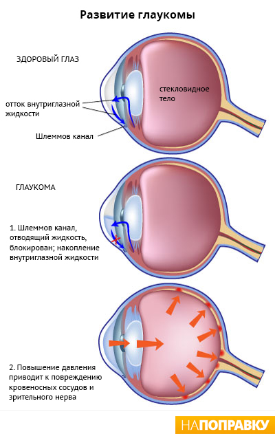 схема развития глаукомы