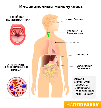 Симптомы инфекционного мононуклеоза (схема)