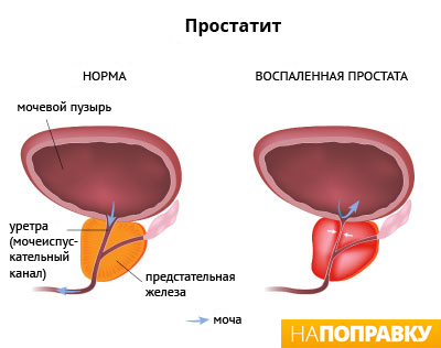 сравнительная анатомия здоровой и воспаленной предстательной железы