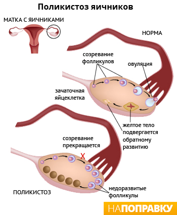 Развитие кист в яичниках при СПКЯ