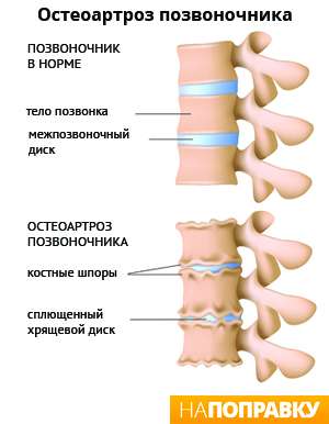 остеоартроз позвоночника