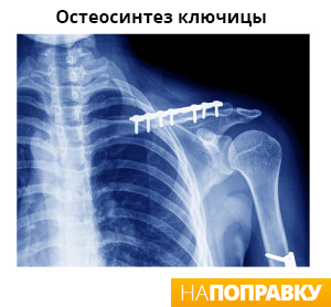 рентгенограмма человека с остеосинтезом ключицы
