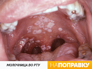Кандидоз полости рта (молочница во рту)+фото