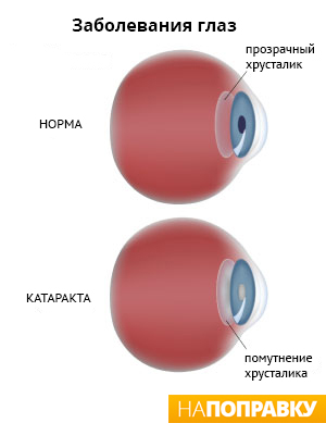 анатомия здорового глаза и глаза с катарактой