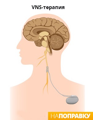Стимуляция блуждающего нерва (VNS-терапия) при эпилепсии (схема)