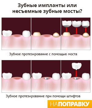 что лучше - зубные импланты или несъемные зубные мосты