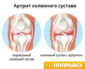 сравнение здорового колена и колена с артритом