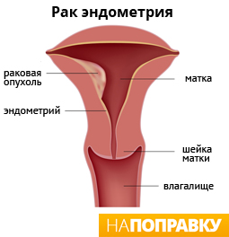 Рак эндометрия (рак тела матки)