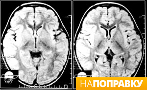 компьютерная томография головного мозга