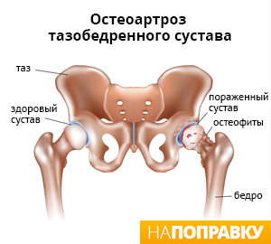 Остеоартроз тазобедренного сустава (схема)