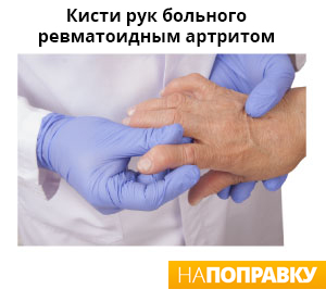 кисти рук больного ревматоидным артритом
