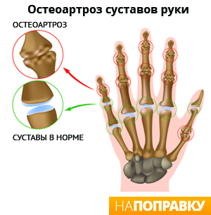 остеоартроз пальцев рук