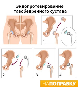 этапы операции по эндопротезированию тазобедренного сустава