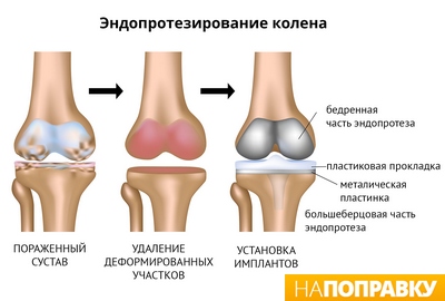 эндопротезирование колена(операция)_готовое.jpg
